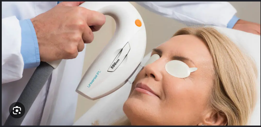 IPL Lumenis Dry